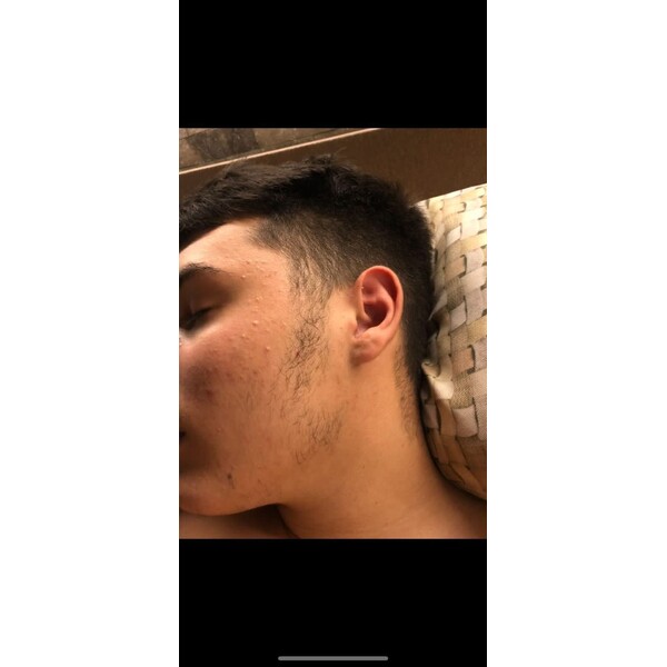 Minoxidil Kirkland 5%, 1 Luna Aplicare, Tratament Pentru Barba / Scalp