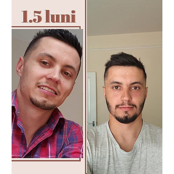 Minoxidil iiSolutions 7,5%, 1 Luna Aplicare, Tratament Pentru Barba/Scalp