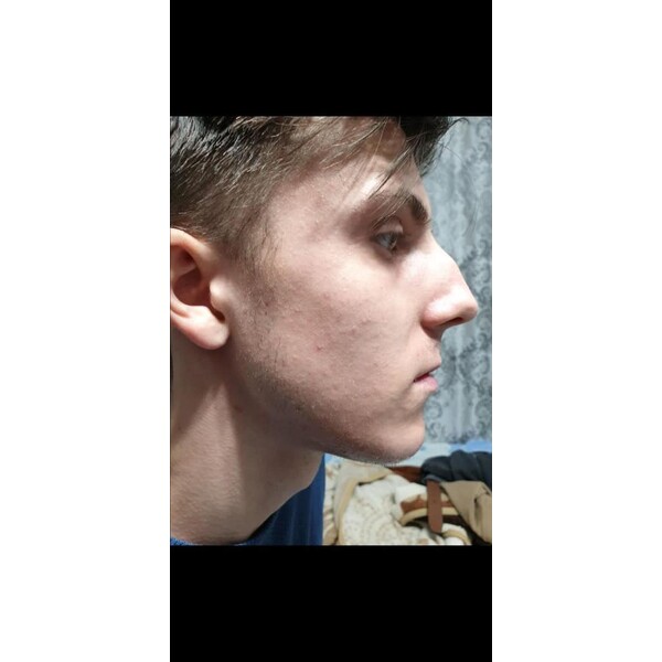 Minoxidil Dualgen 5% - Absorbtie Rapida, fara PG, 1 lună aplicare, Tratament Pentru Barba / Scalp