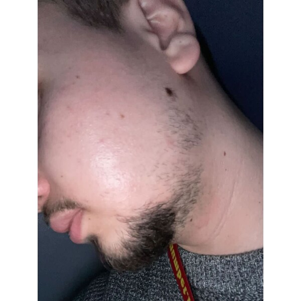 Minoxidil Foligain 5%, 3 Luni Aplicare +Dermaroller, Tratament Pentru Barba / Scalp