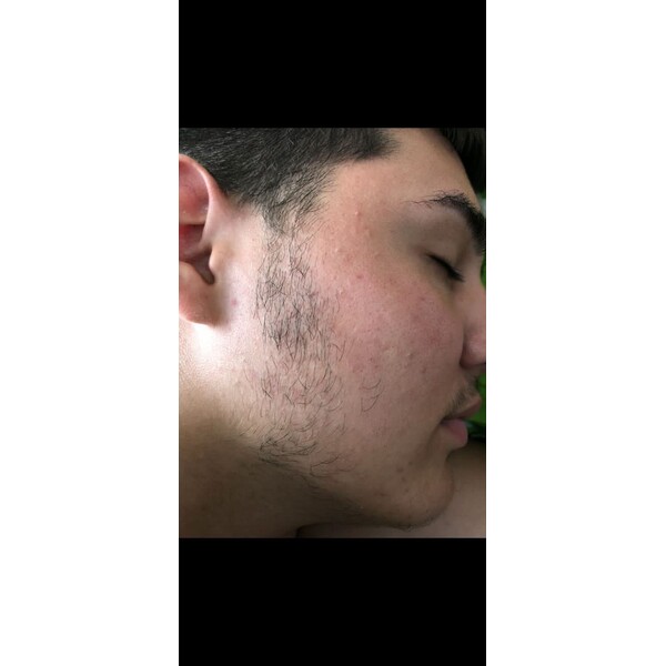 Minoxidil Kirkland 5%, 1 Luna Aplicare, Tratament Pentru Barba / Scalp