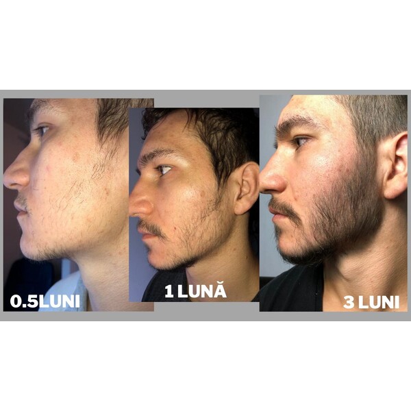 Minoxidil iiSolutions 7,5%, 1 Luna Aplicare, Tratament Pentru Barba/Scalp