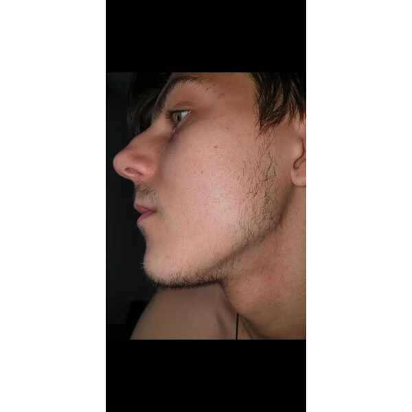 Minoxidil Dualgen 5% - Absorbtie Rapida, fara PG, 1 lună aplicare, Tratament Pentru Barba / Scalp