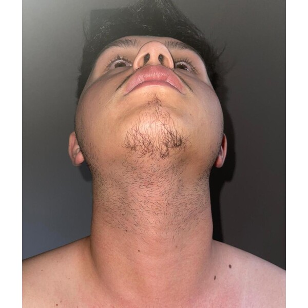 Minoxidil EssenGen 5% - Absorbtie Rapida, fara PG, 1-2 luni aplicare, Tratament Pentru Barba / Scalp, Unisex