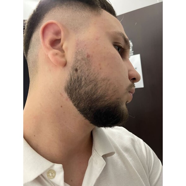 Minoxidil Foligain 5%, 3 Luni Aplicare +Dermaroller, Tratament Pentru Barba / Scalp