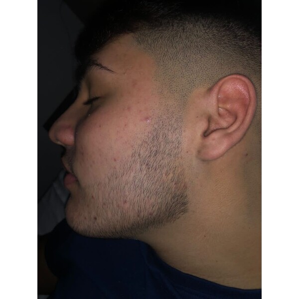 Minoxidil Kirkland 5%, 1 Luna Aplicare, Tratament Pentru Barba / Scalp