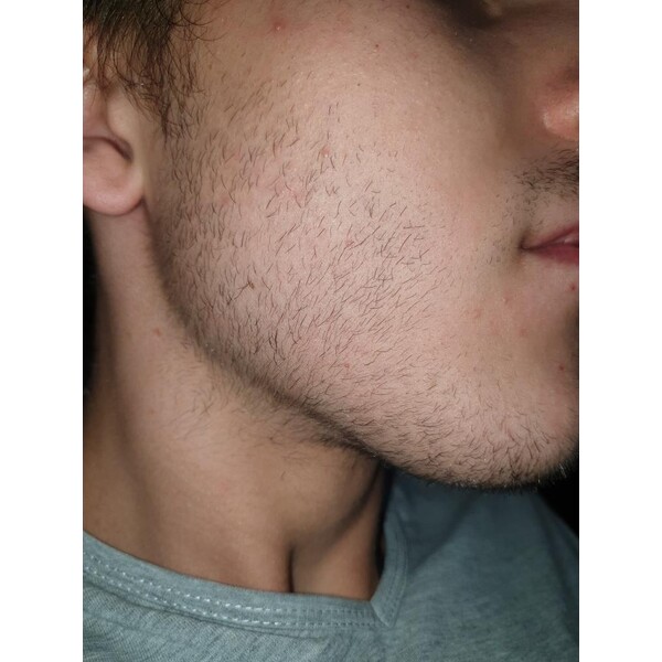 Minoxidil Dualgen 5% - Absorbtie Rapida, fara PG, 1 lună aplicare, Tratament Pentru Barba / Scalp