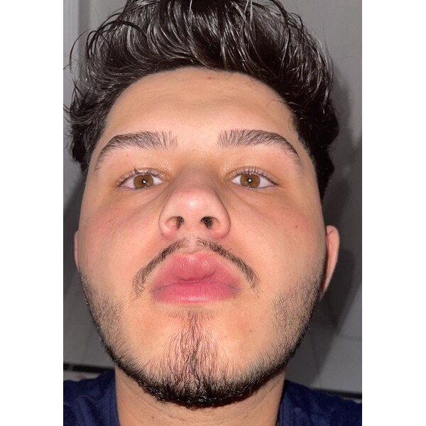 Minoxidil EssenGen 5% - Absorbtie Rapida, fara PG, 1-2 luni aplicare, Tratament Pentru Barba / Scalp, Unisex