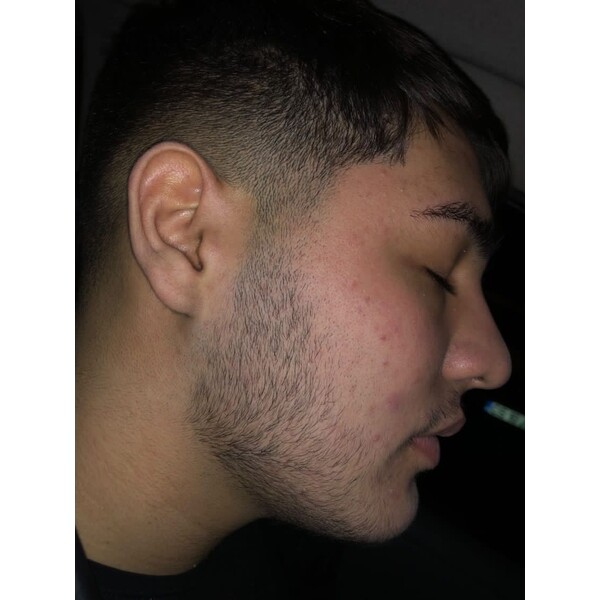 Minoxidil Kirkland 5%, 1 Luna Aplicare, Tratament Pentru Barba / Scalp