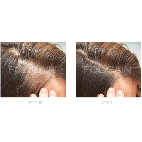 Spuma pentru regenerarea parului FOLIGAIN Minoxidil 2% pentru femei - Tratament pentru 3 luni