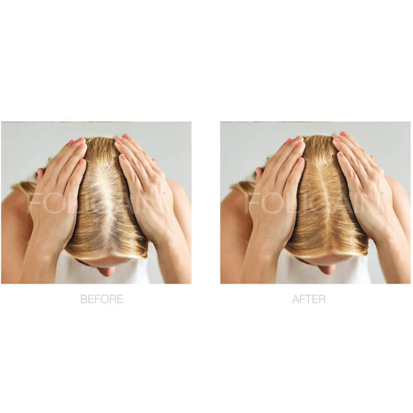 Spuma pentru regenerarea parului FOLIGAIN Minoxidil 2% pentru femei - Tratament pentru 3 luni