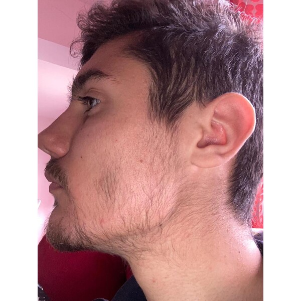 Minoxidil Foligain 5%, 1 Luna Aplicare, Tratament Pentru Barba/Scalp - Cantitate de Alcool redusa