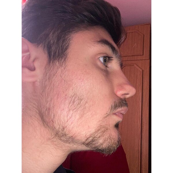 Minoxidil Foligain 5%, 1 Luna Aplicare, Tratament Pentru Barba/Scalp - Cantitate de Alcool redusa