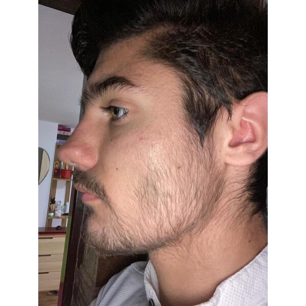 Minoxidil Foligain 5%, 1 Luna Aplicare, Tratament Pentru Barba/Scalp - Cantitate de Alcool redusa