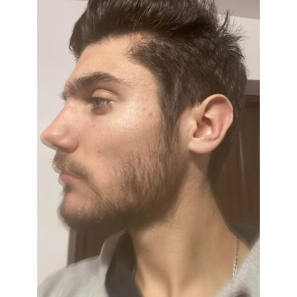 Minoxidil Foligain 5%, 1 Luna Aplicare, Tratament Pentru Barba/Scalp - Cantitate de Alcool redusa