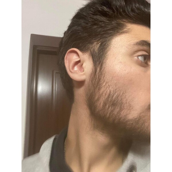 Minoxidil Foligain 5%, 1 Luna Aplicare, Tratament Pentru Barba/Scalp - Cantitate de Alcool redusa