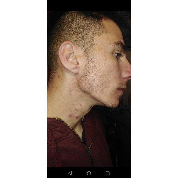 Spuma - Minoxidil Rogaine 5%, 1 Luna Aplicare, Tratament Pentru Barba / Scalp