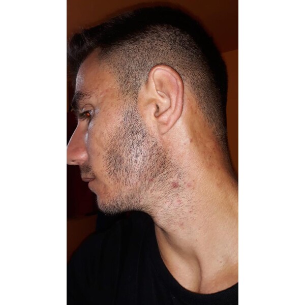 Spuma - Minoxidil Rogaine 5%, 1 Luna Aplicare, Tratament Pentru Barba / Scalp