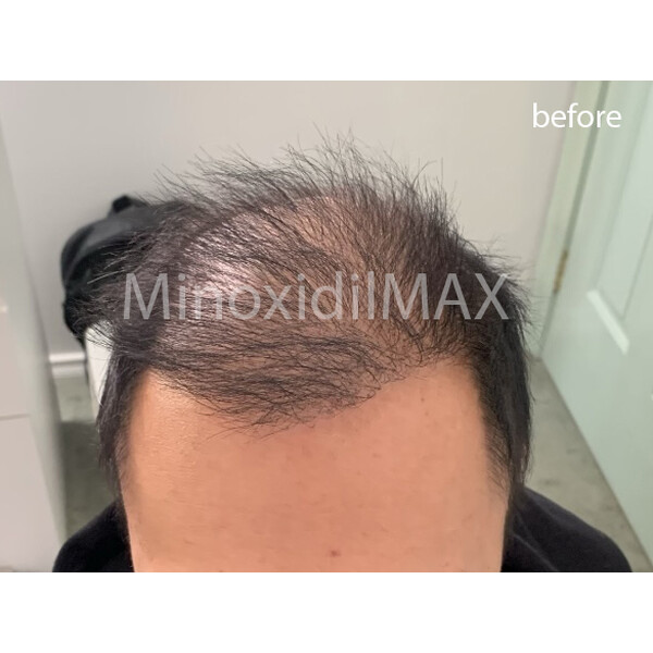 Minoxidil 7% Maxogen - X cu Finasteride 0.15%, Absorbtie Rapida, Tratament pentru 2 Luni, 60 ml