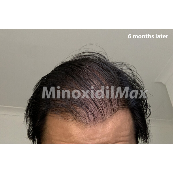 Minoxidil 7% Maxogen - X cu Finasteride 0.15%, Absorbtie Rapida, Tratament pentru 2 Luni, 60 ml