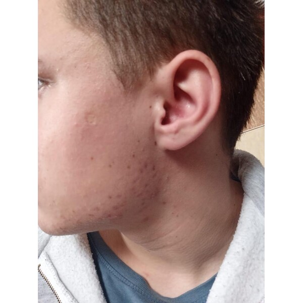 Minoxidil Regaine 5%, 1 Luna Aplicare, Tratament Pentru Barba / Scalp